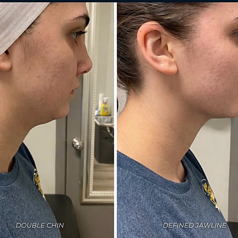 Double Chin Slim & Tone at SkinnyGlow in La Quinta, CA