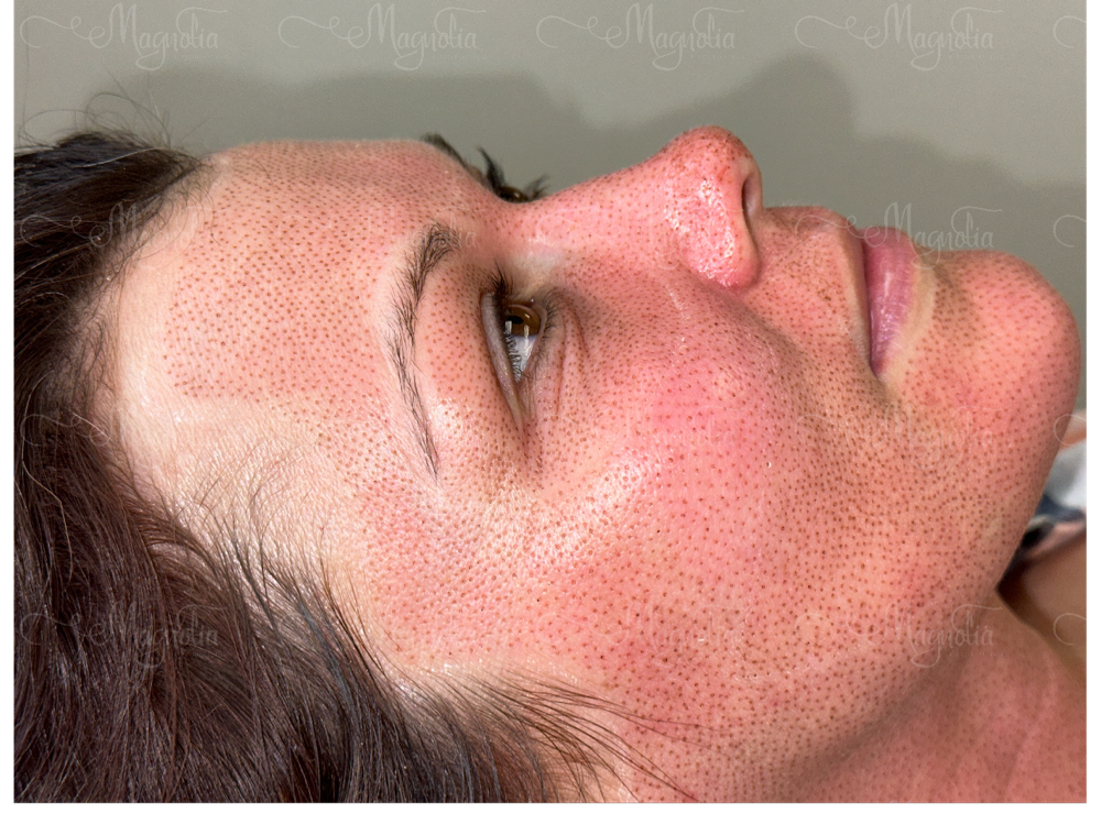 Full Face Lift (deposit Via Zelle)