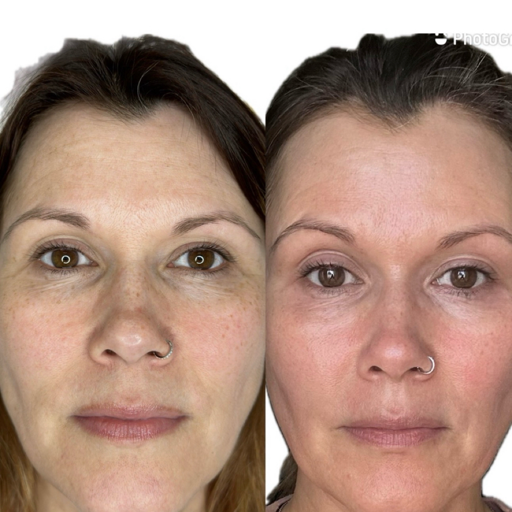 Full Face Lift (deposit Via Zelle) at Magnolia Plasma Fibroblasting By Mitra in Frisco, TX
