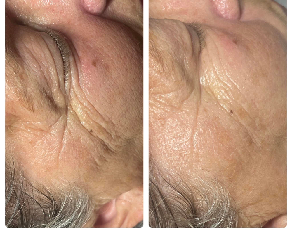 The VTox Facial