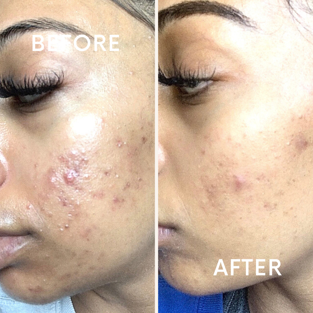 Acne Scar Peel at Beautify Your Skin in Campbell, CA