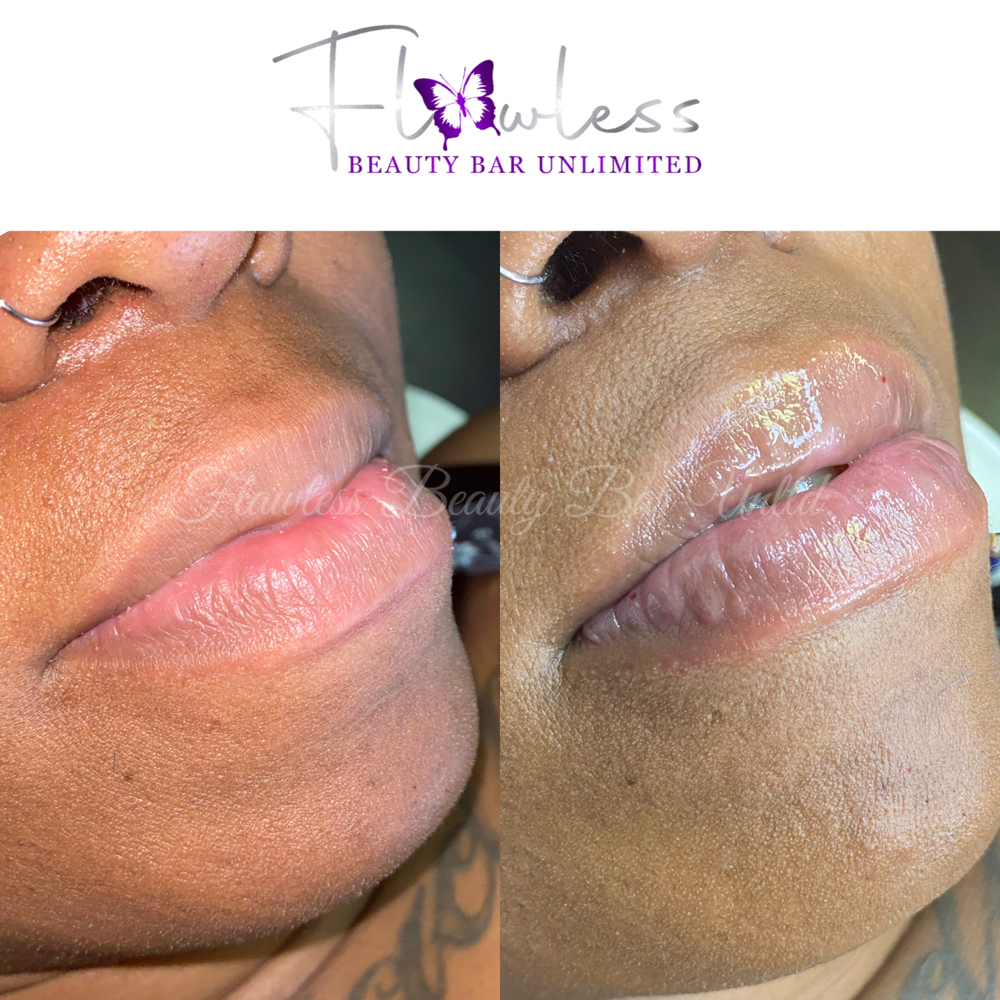 HYA Lip Fillers