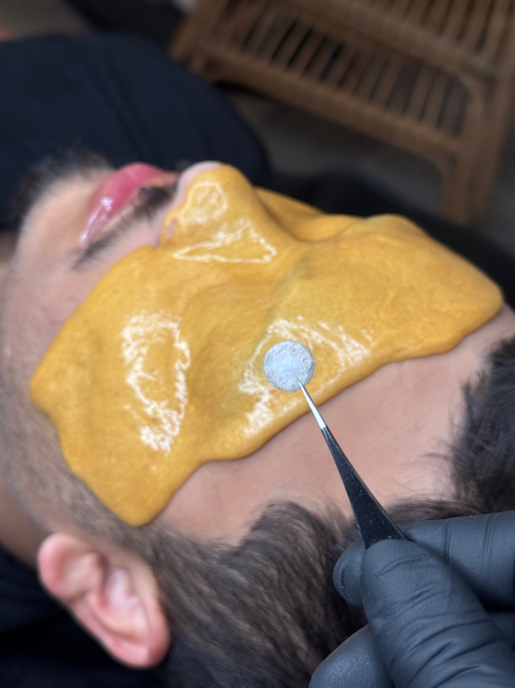 Microdermabrasion Facial