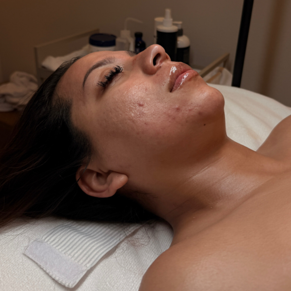 Acne Peel at Beautifully Esthetics in Costa Mesa, CA