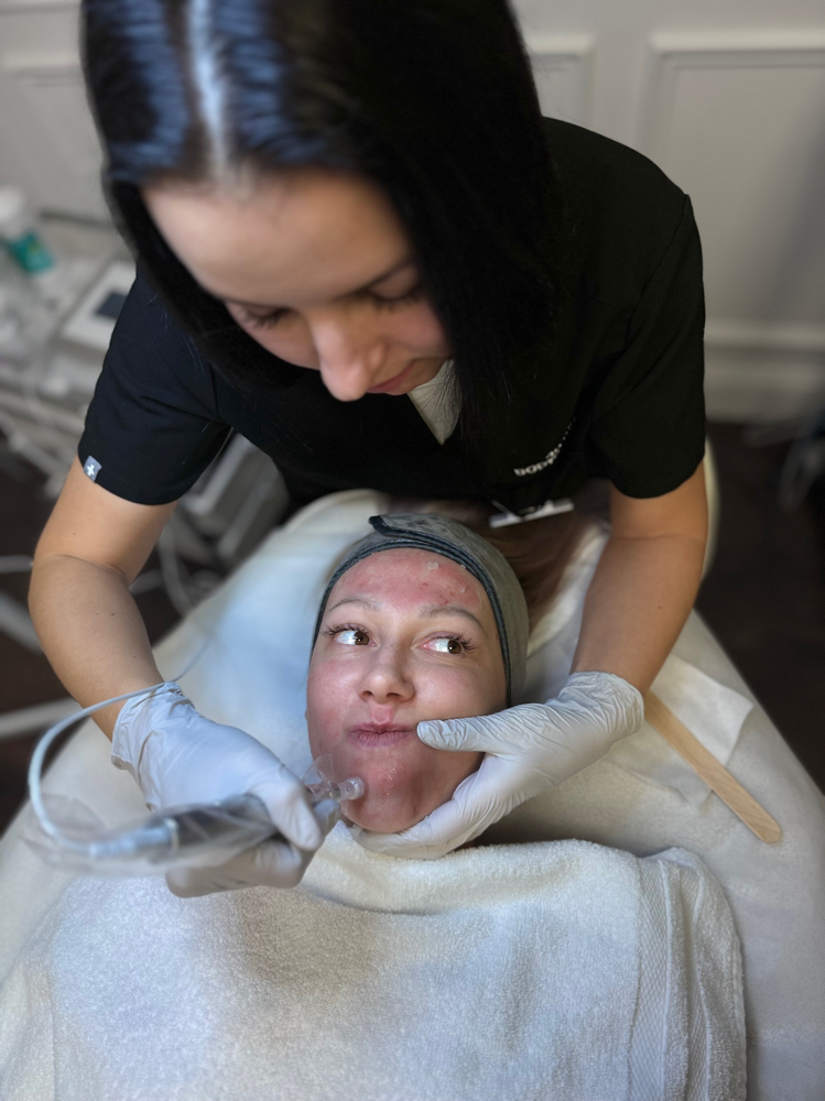 MickroNeedling Scalp Signature