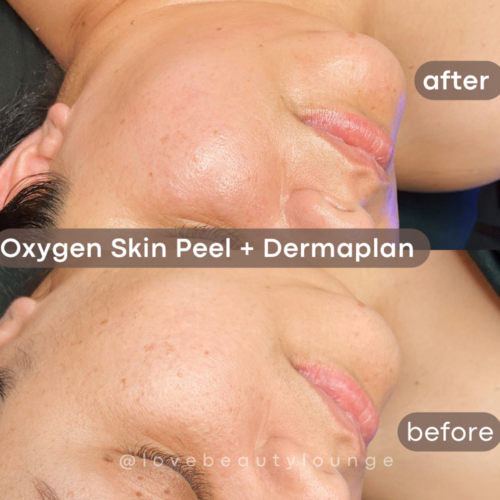 Oxygen Skin Regenrative Peel