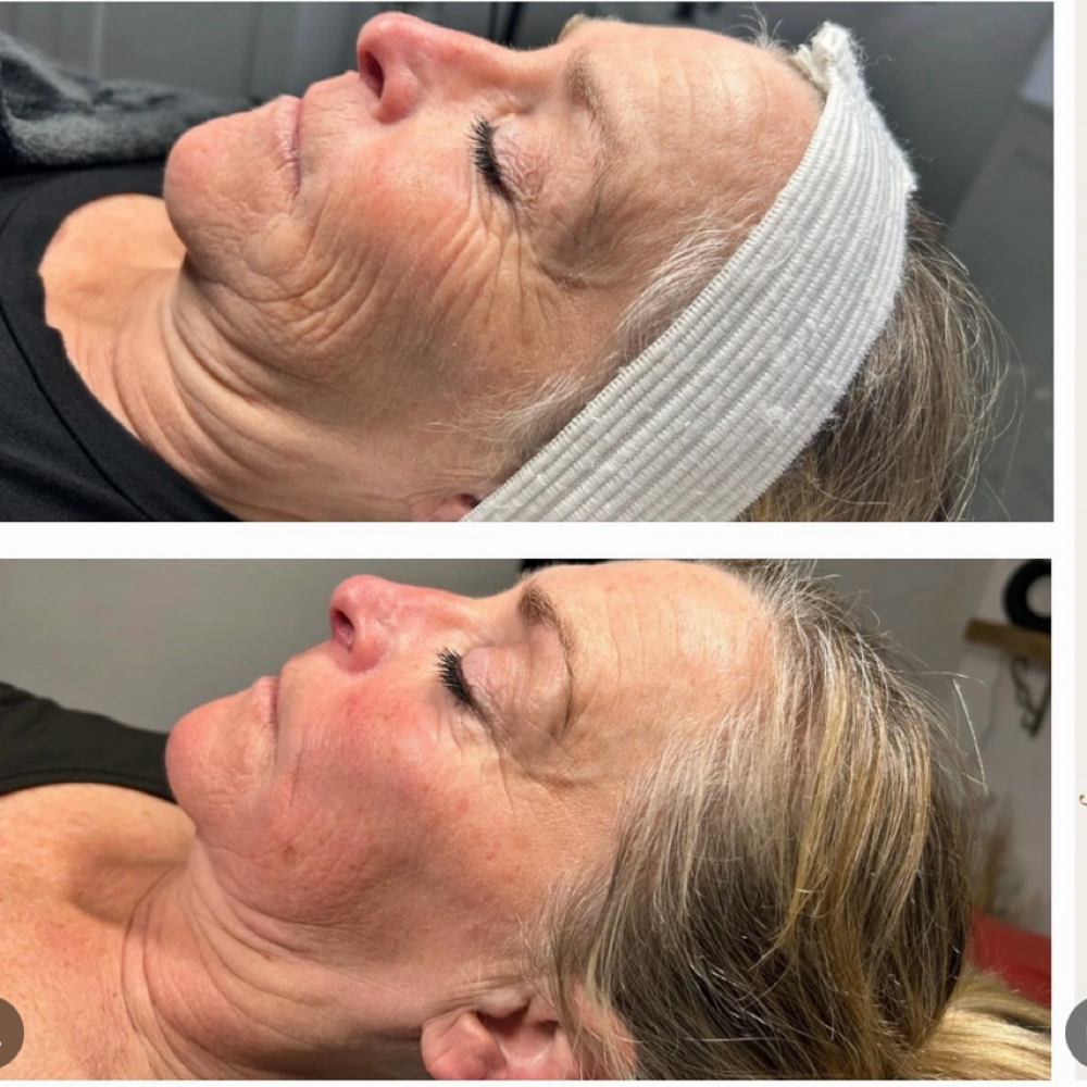 Renewal & Reset Facial at SKINSPOT ADVANCED AESTHETICS in TAUNTON, MA