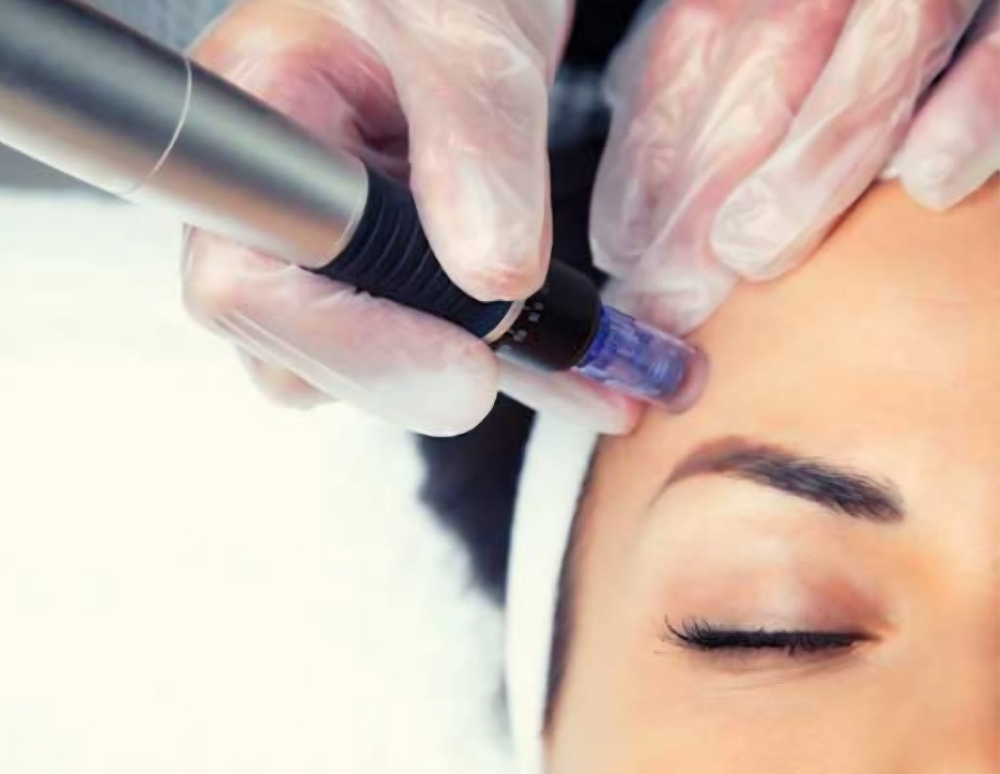 Microneedling (Face + Neck) at High Desert Glow in Santa Fe, NM