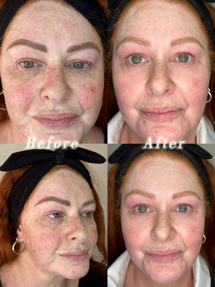 Plasma Skin Rejuvenation