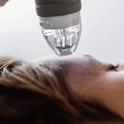 Microneedling at Skintastic Spa Boutique in Philadelphia, PA