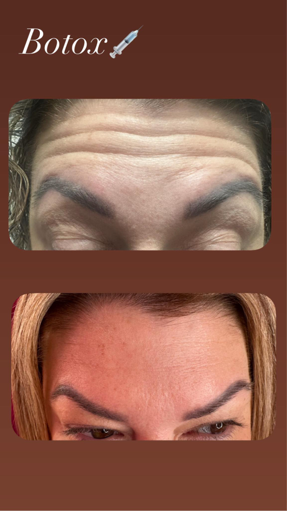 Botox