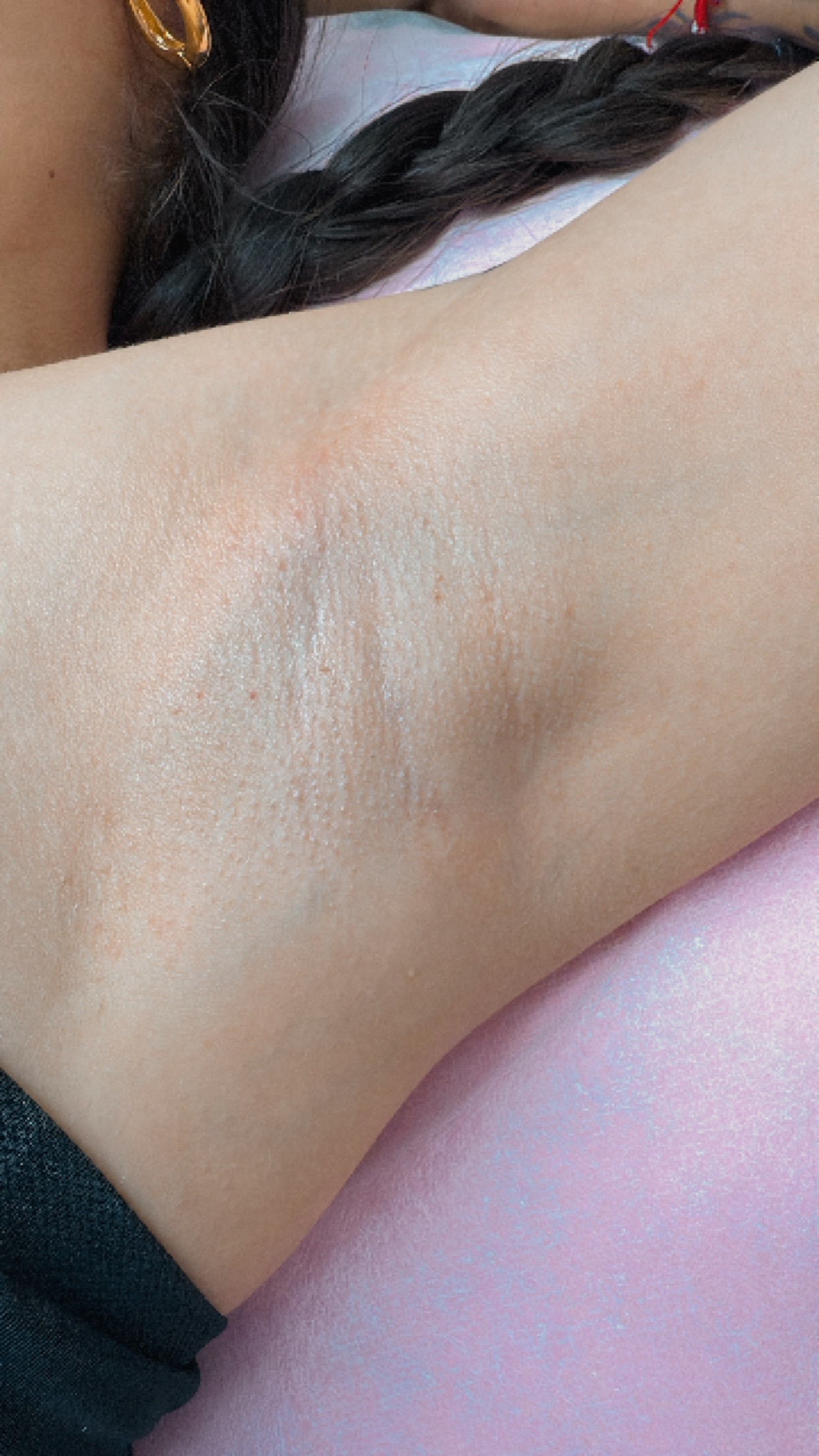 4 Sessions skin lightening Underarm
