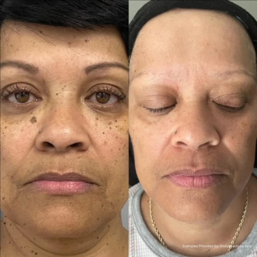 DPN follow up treatment