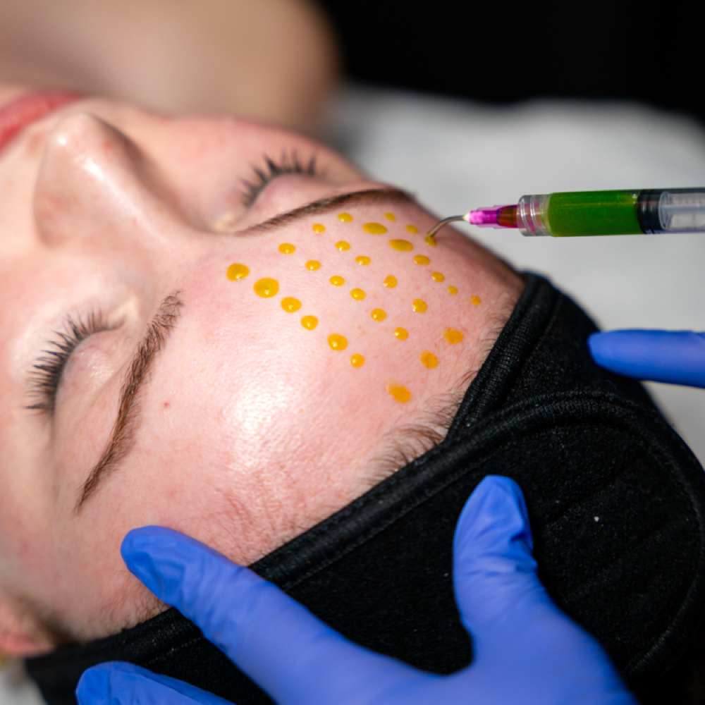 Peel & Perfect at NuSkyn Studio in Dania, FL
