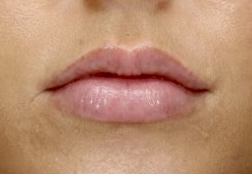 PCA Lip Renewal