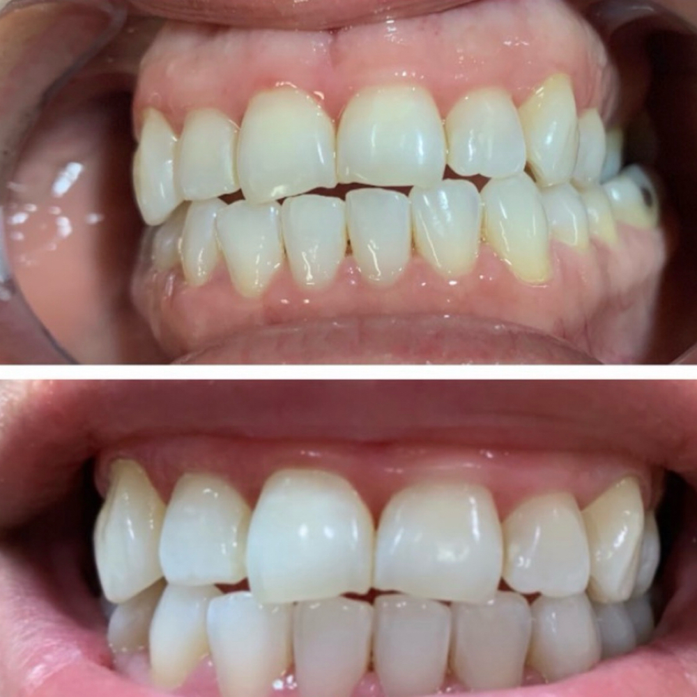 30 Min Express Whitening at KB Beauty Bar in Lake Elsinore, CA