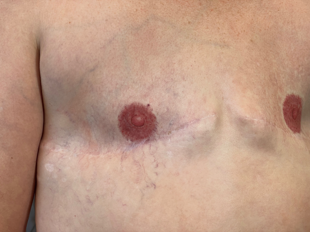 3D Areola Restoration