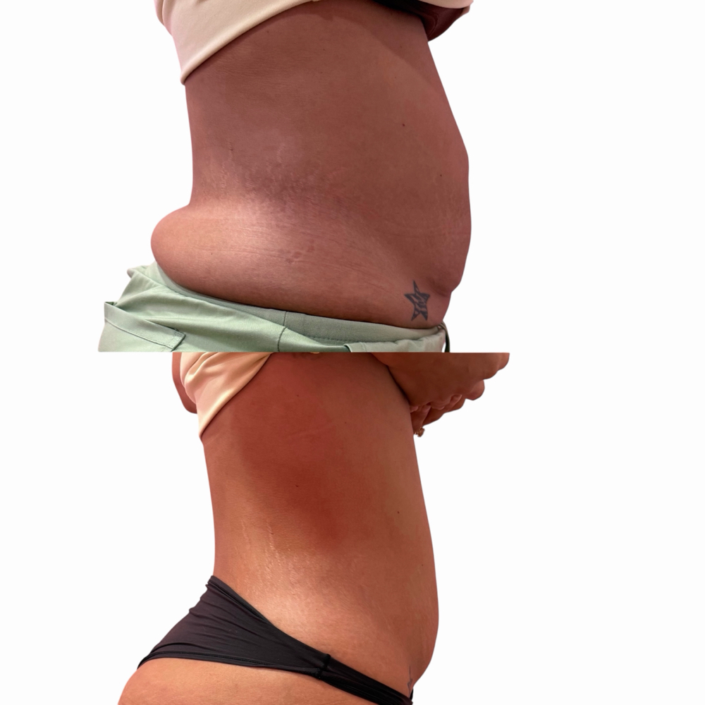 Super Slim Package at The Sculpting Spa in Alice, TX