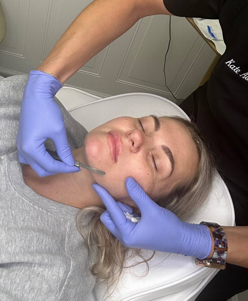 Dermaplaning