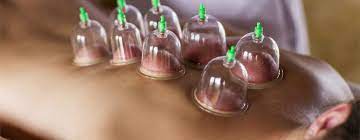 Cupping Therapy