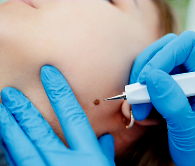 Skin Tag Removal at Soulmate Skin & Wellness in Alton, TX