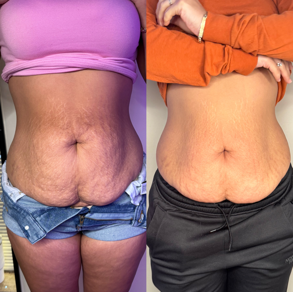 Skin Tightening
