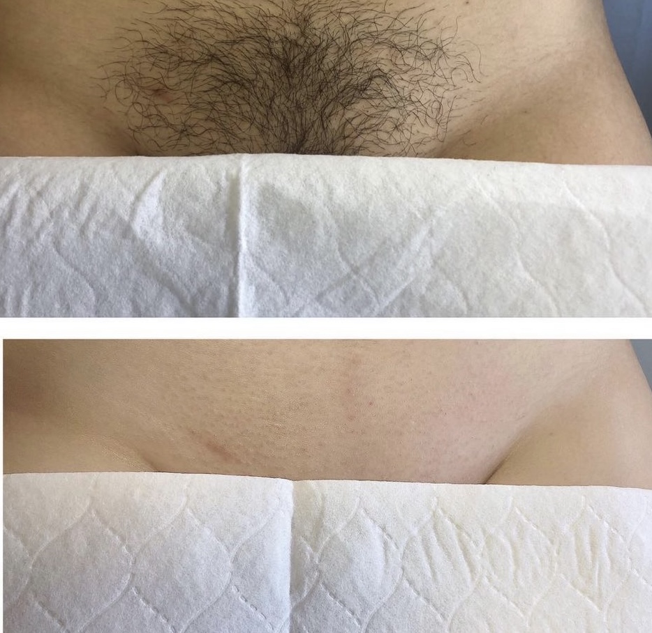 Brazilian Wax