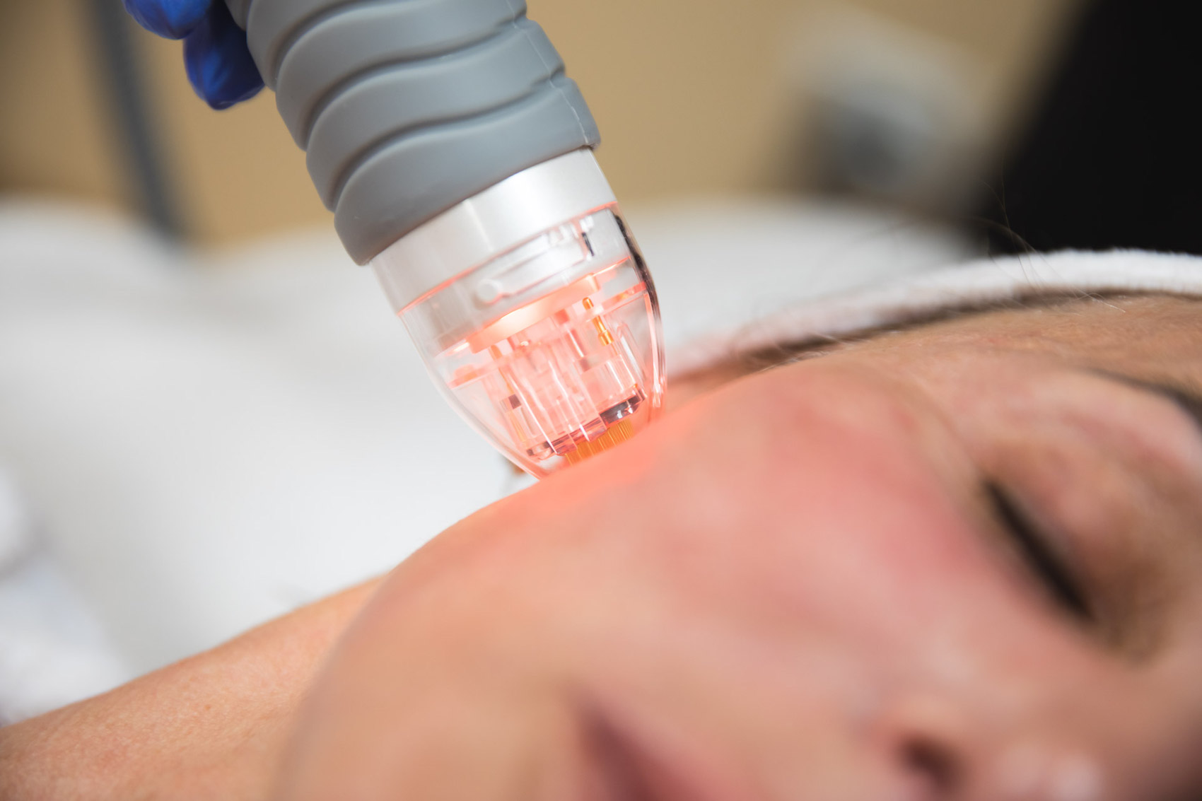 Radiofrequency Microneedling