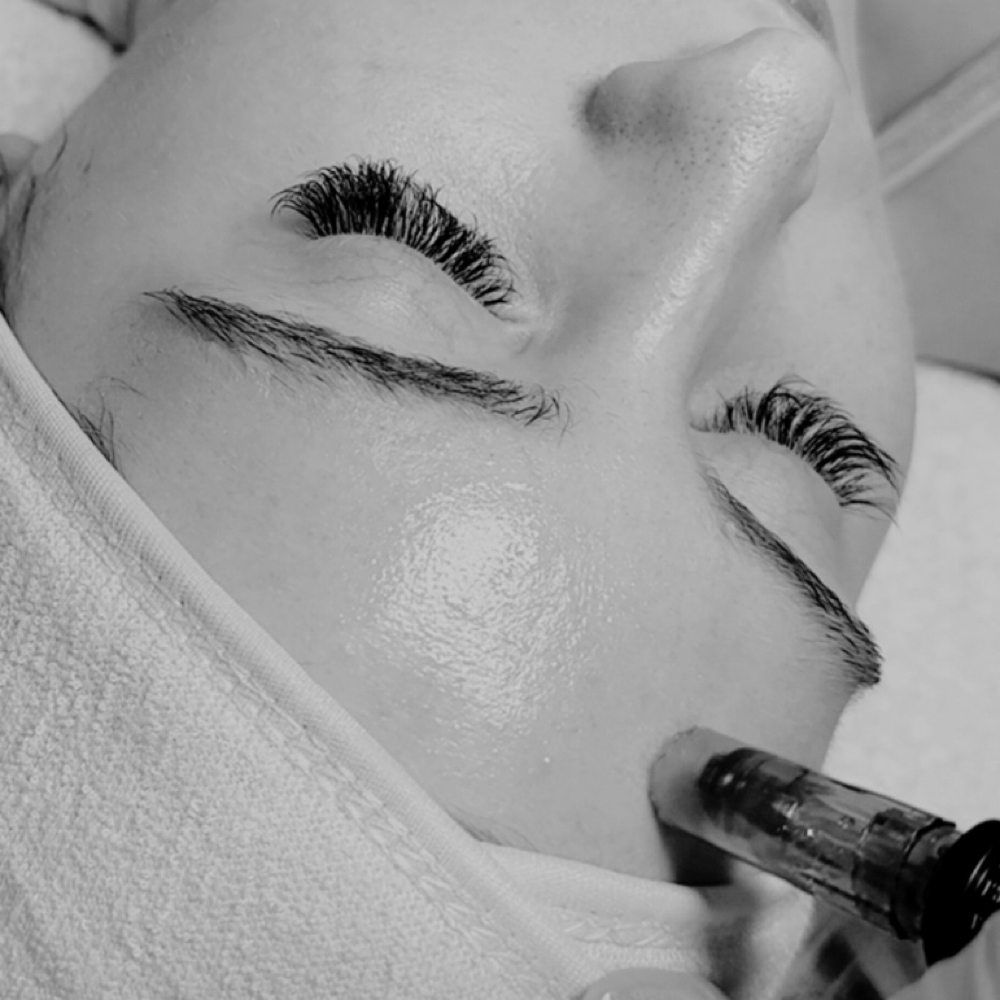 Microneedling Facial Treatment at Bare Aesthetics By Chloe in Lake Norman of Catawba, NC