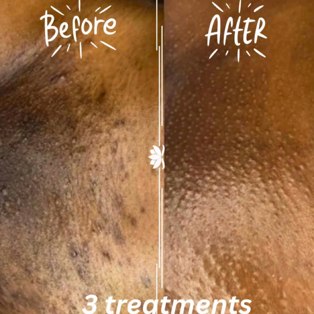 BioPeel at Solskyluna Suites in Methuen, MA
