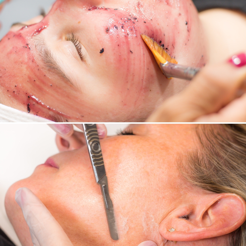 DERMAPLANING W/ ENZYME PEEL at Skin & Soul Skincare LLC in Tucson AZ, AZ