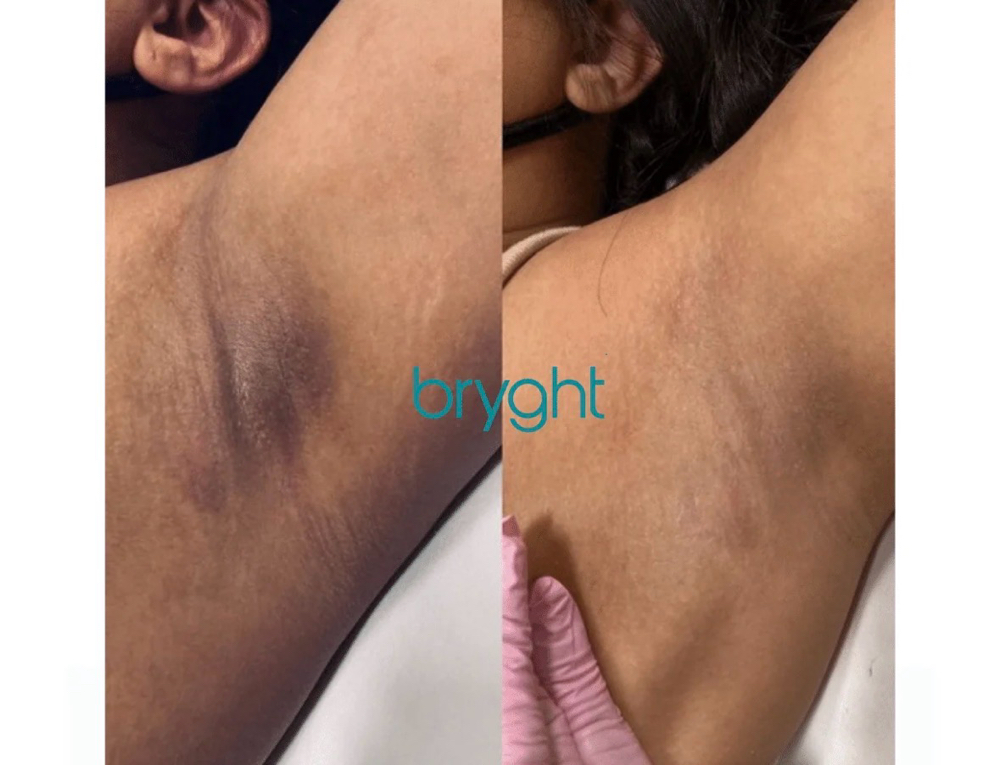 Skin Lightening using Bryght