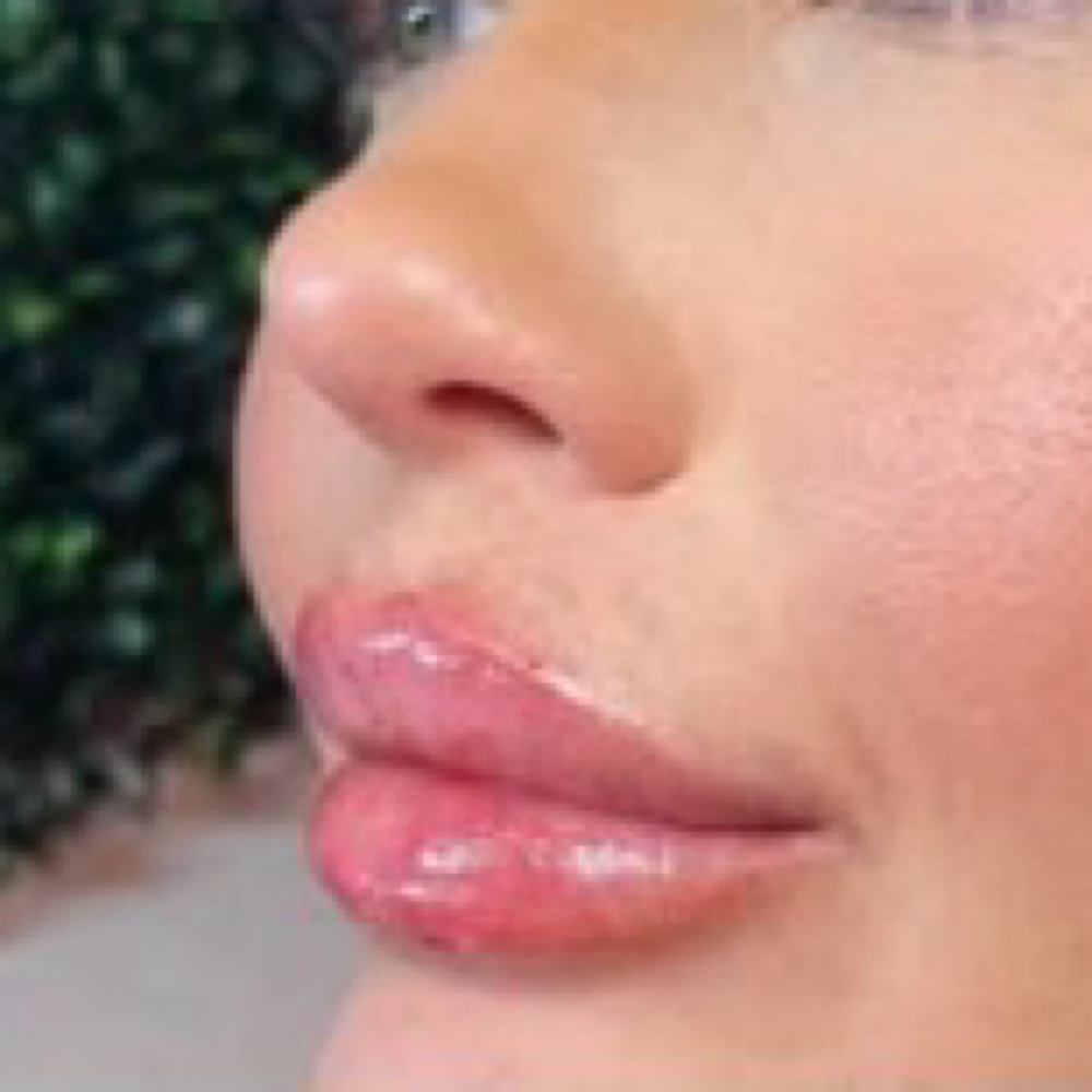RHA, KYSSE LIP FILLER at Sittin’ Pretty Headspa & Aesthetics in Corpus Christi, TX