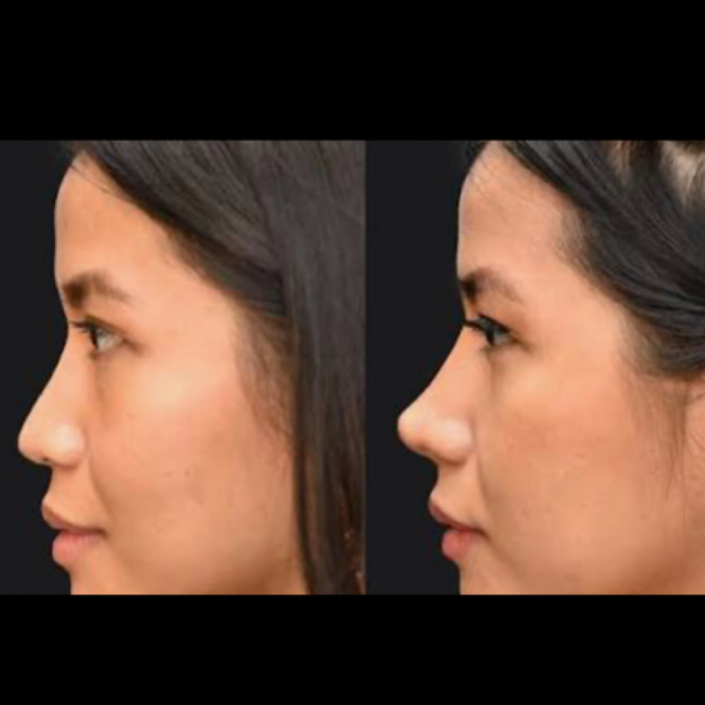 Neurotoxin Tinker Bell Nose Lift at Beauty Lounge Prosper in McKinney, TX