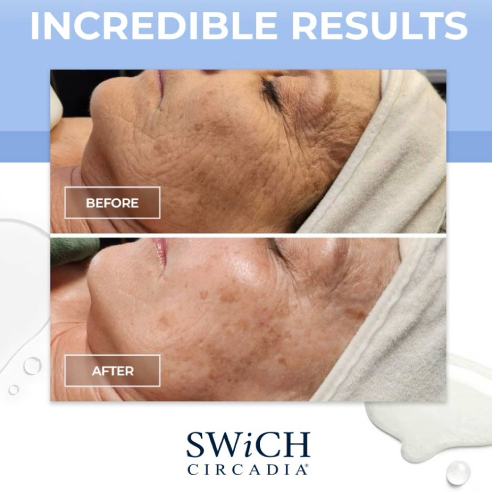 SWiCH Rejuvination Treatment at Skin Matters in Hilton Head Island, SC