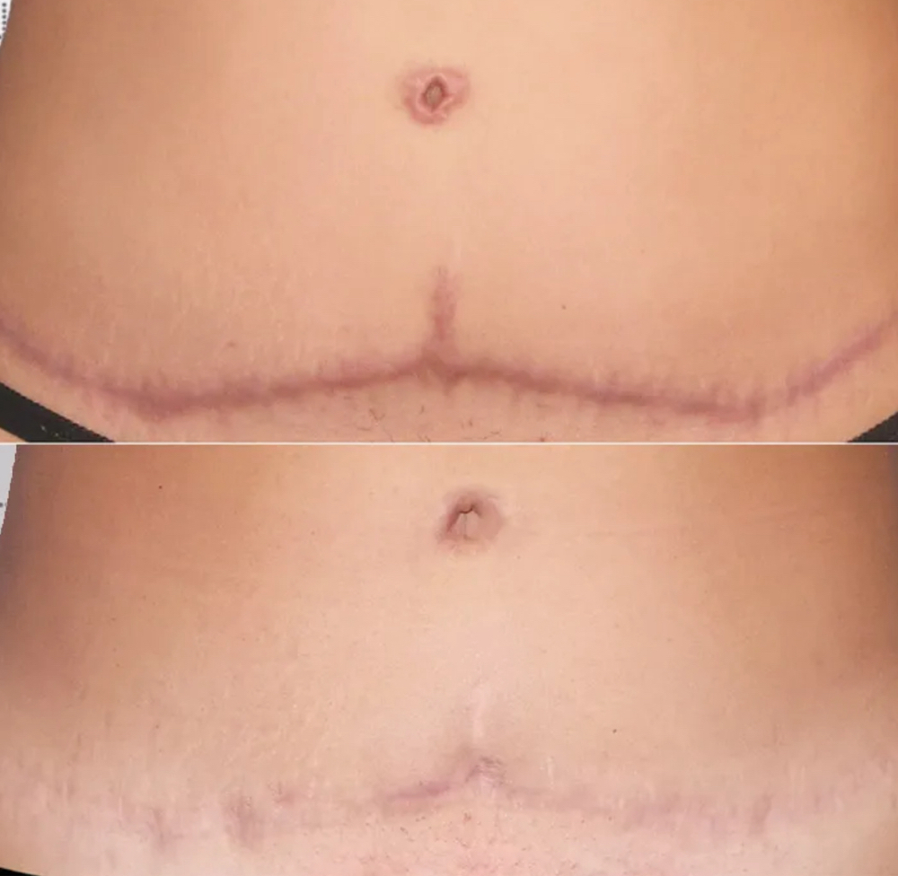 Inkless Paramedical tattoo w/ Serum