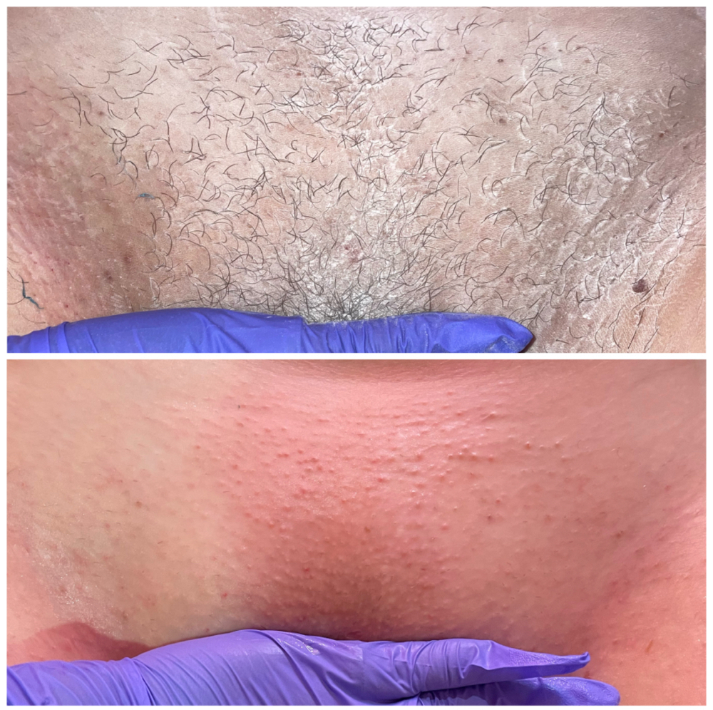 Brazilian Wax