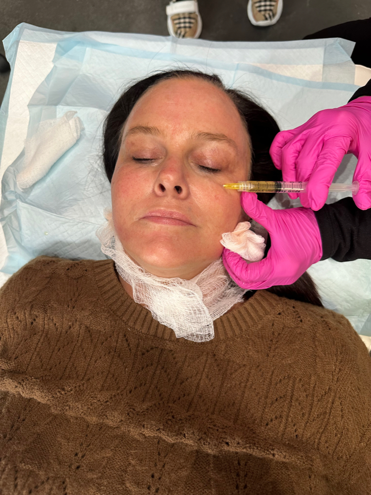 PRF undereyes