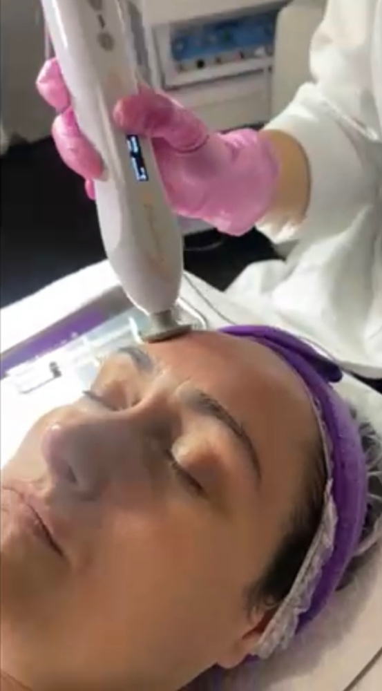 PLASMA LIFT (NON-ABLATIVE)