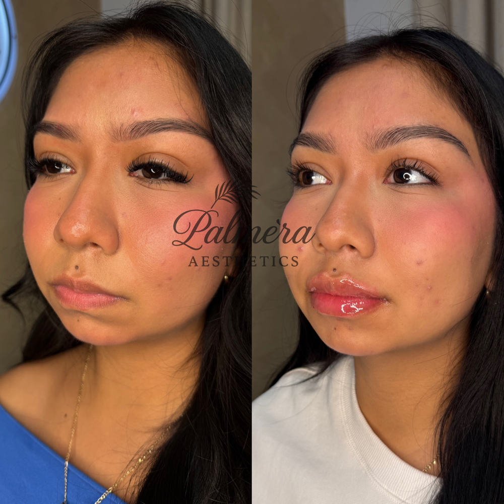 Lip Refresh 0.6ML at Palméra Aesthetics in Killeen, TX