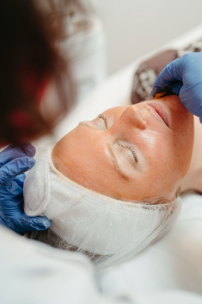 Acne Chemical Peel at The Twisted Angel Salon & Spa in Bloomington, IN