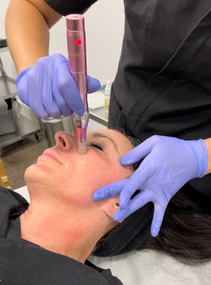 Collagen Induction Facial