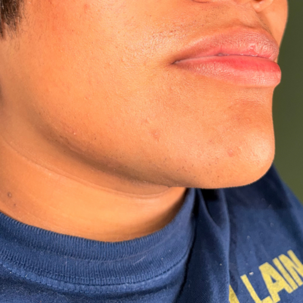 Chin Wax at Radiance Aesthetics by Aracely in Bakersfield, CA