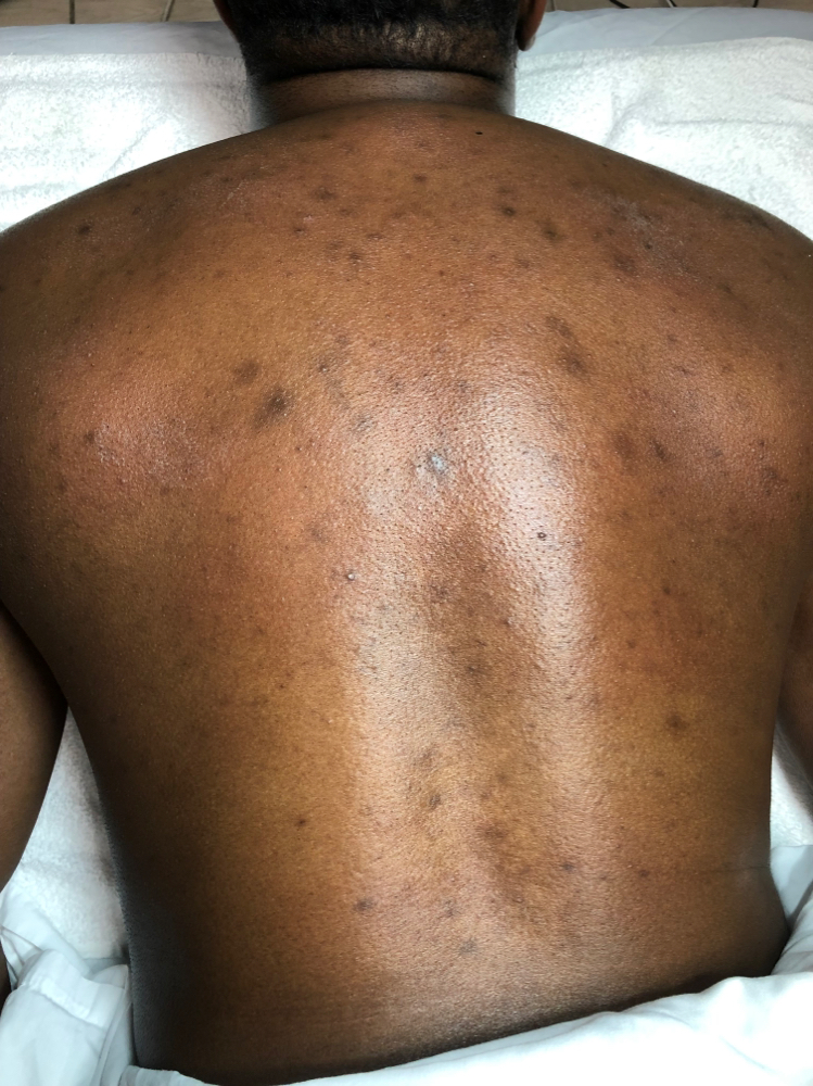 Full Back Peel at Jisell Aesthetics in Houston, TX