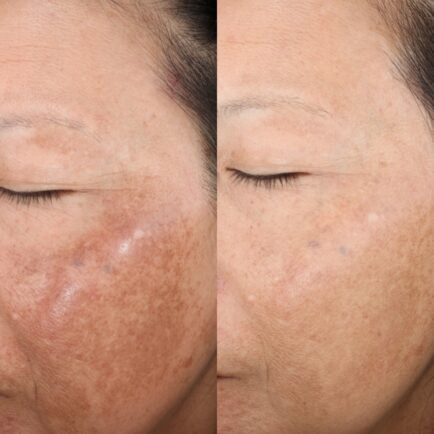 Chemical Peel (Professional Grade)