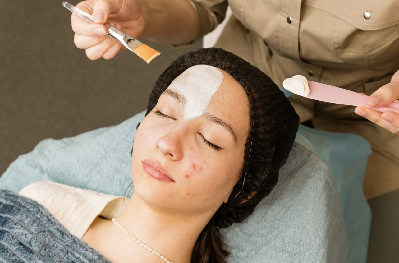 Acne Facial Promo $67