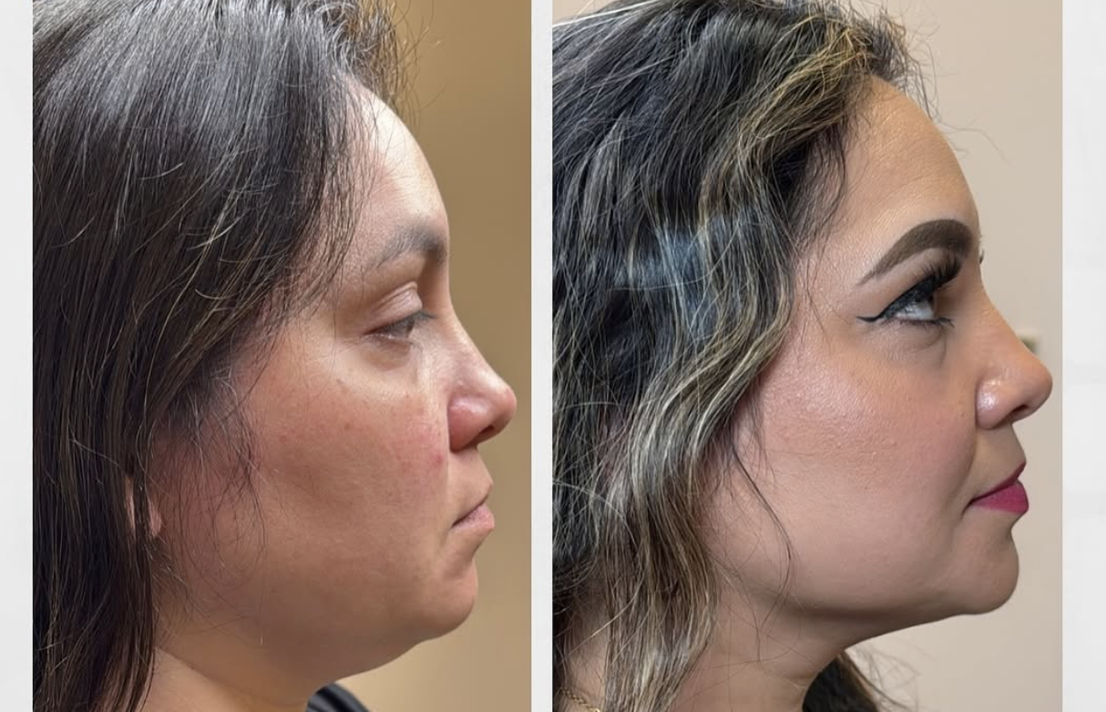Double Chin - Lipo Dissolve