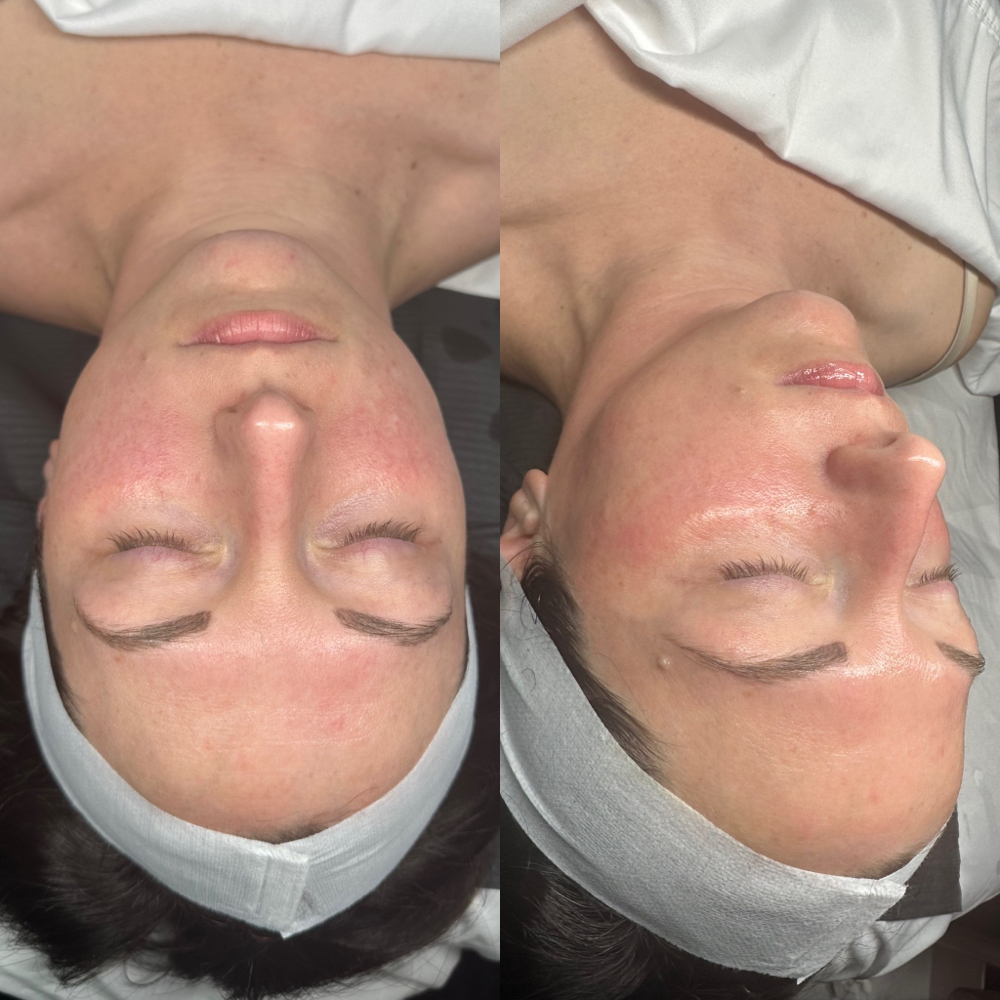 Shine Bright Dermaplane Facial