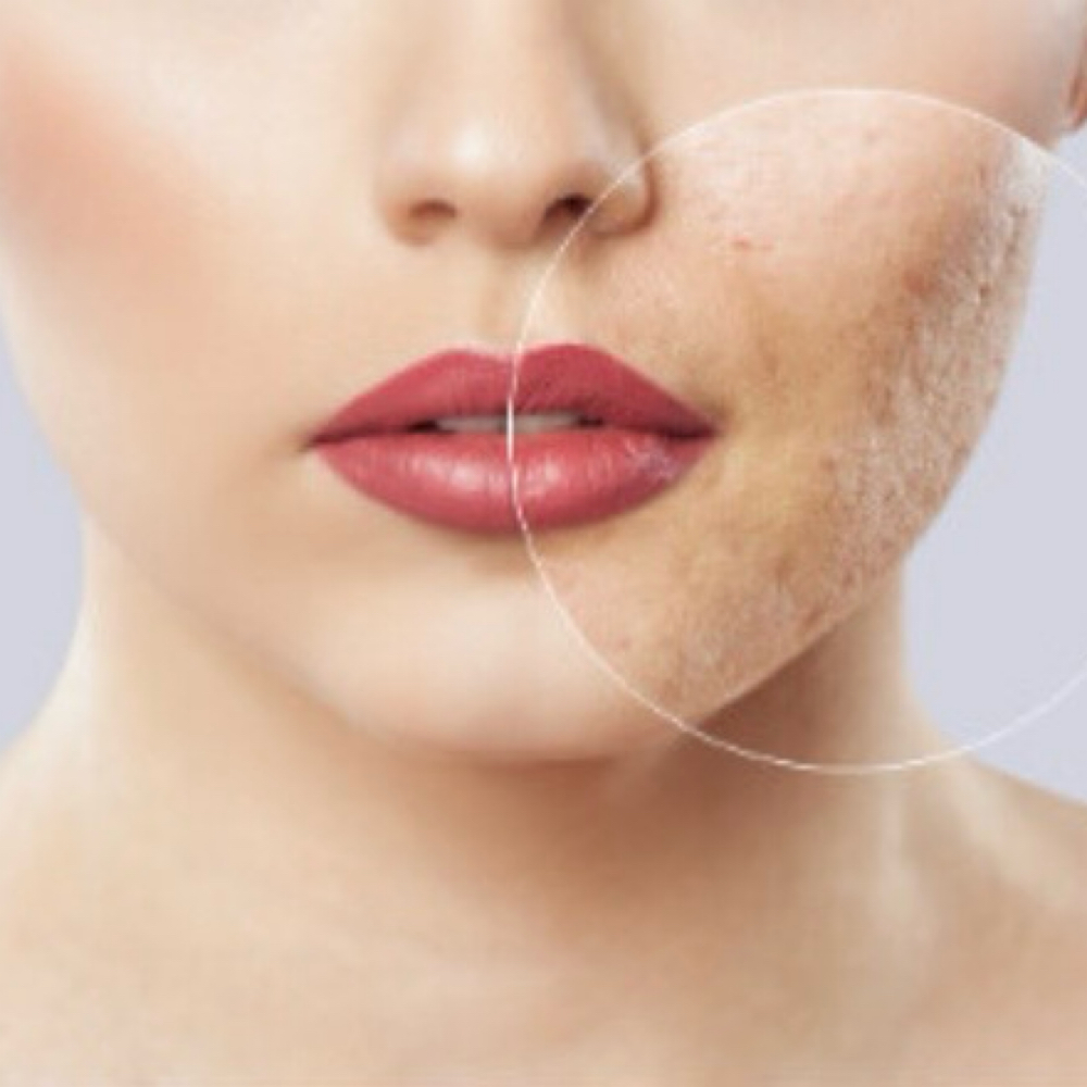 Acne Prescription Consultation