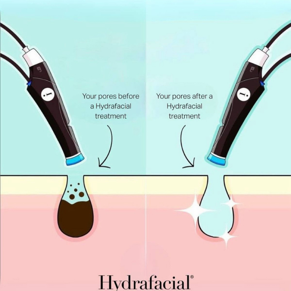 PLATINUM HYDRAFACIAL at Vera Luna Beauty Collective in Rapid City, SD